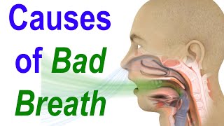 Sources of Bad Breath or Halitosis Evaluate Diagnose and Treat [upl. by Pelletier]