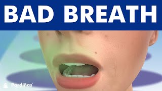 Bad Breath  Halitosis causes and treatment © [upl. by Augy]