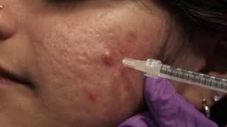 Watch amp Learn Intralesional injections [upl. by Initsed]