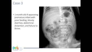 Approach to Pediatric Abdominal Xrays [upl. by Polloch]