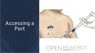 Accessing a Port by P Dockx  OPENPediatrics [upl. by O'Carroll930]