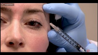 Brow Lift Masseter Frontalis and Glabella Botox Treatment  AAFE [upl. by Glynn530]